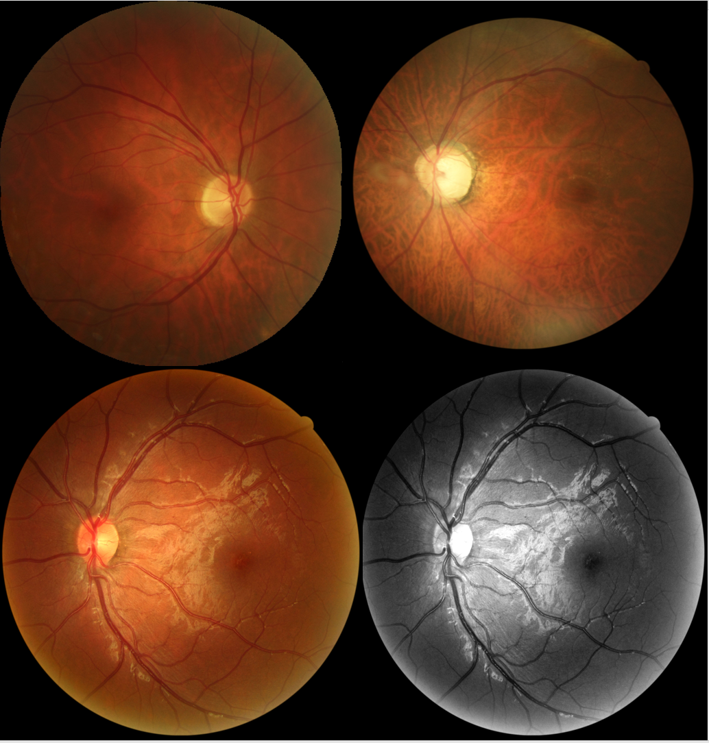 Teleophthalmology EyeWiki