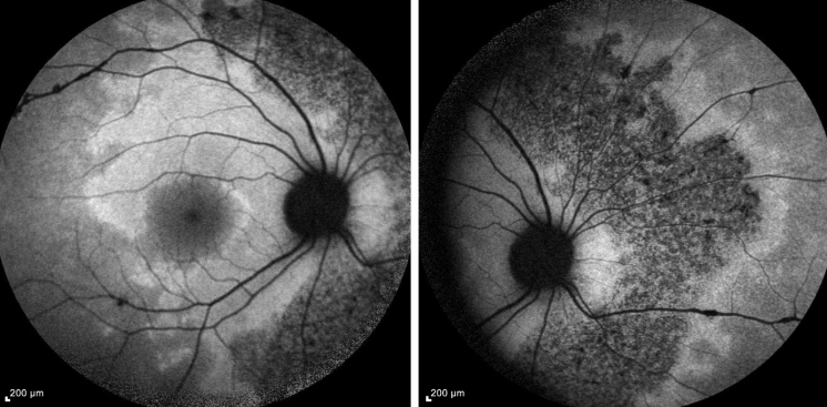 Pigmented Paravenous Retinochoroidal Atrophy EyeWiki