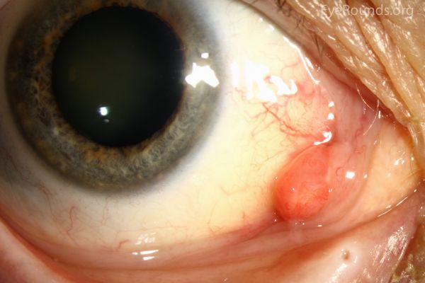 Pyogenic Granuloma Eyewiki