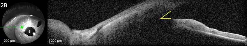 Figure 2B. Anterior segment optical coherence tomography showing a deep  irido-corneal angle (outlined in yellow)