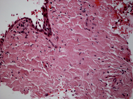 Figure 2: Conjunctival amyloidosis. Hematoxylin and eosin stain of conjunctival tissue biopsy. Extensive hyalinization and diffuse eosinophilic extracellular material consistent with amyloidosis. (Image courtesy of Paul J. Bryar, MD)