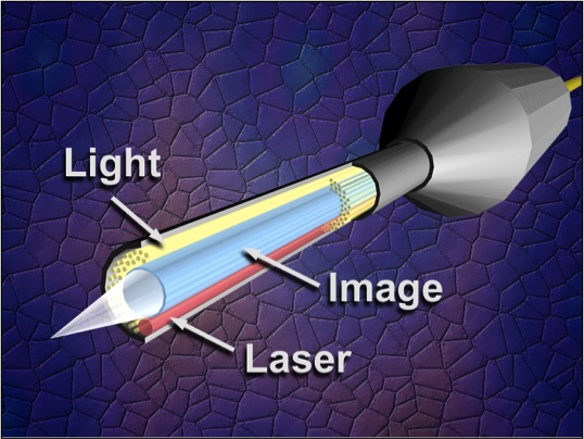 Endoptiks ECP Laser Probe