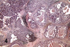 Primary Adenocarcinoma.jpg