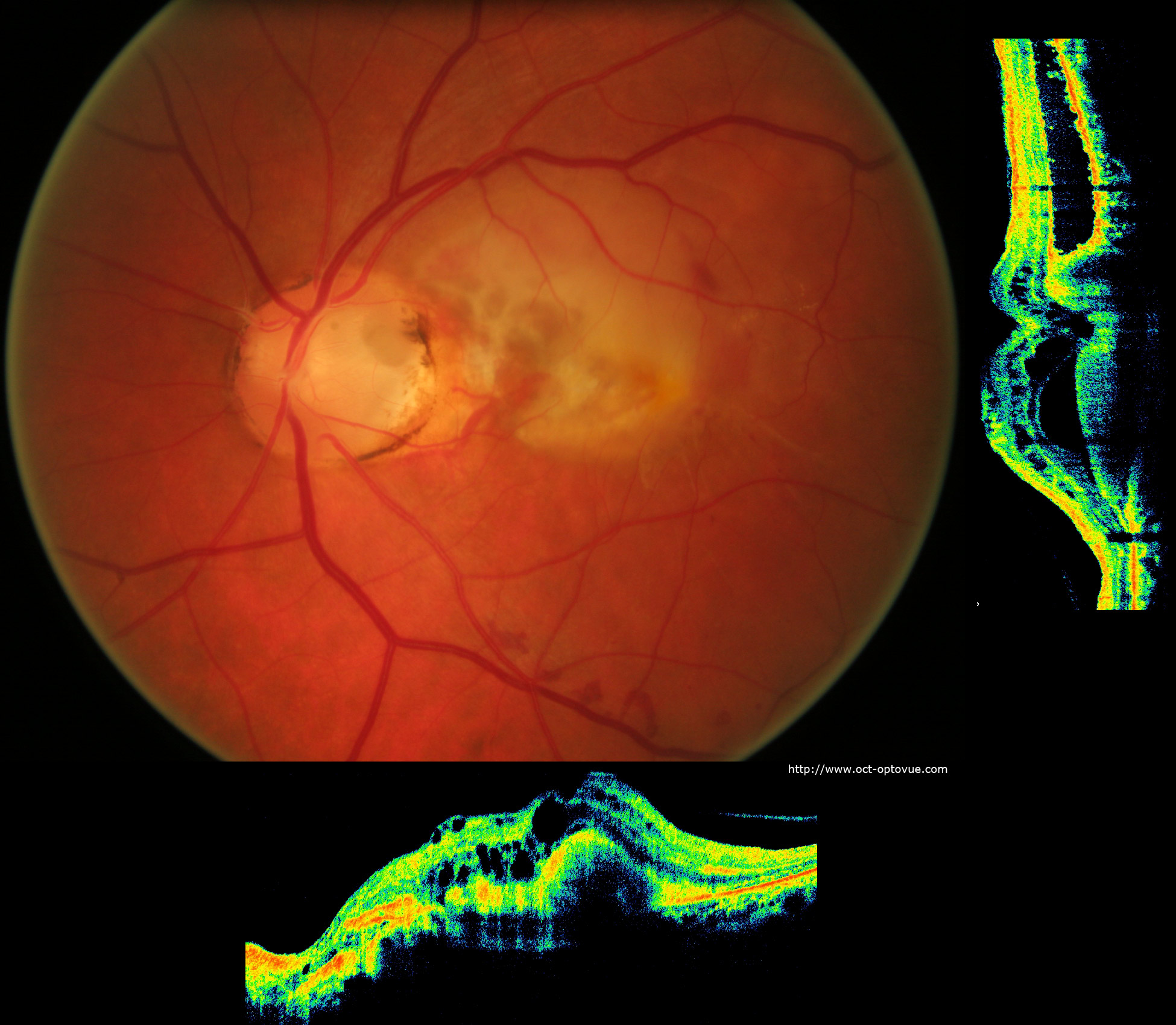 Optic pits: Color fundus photo and corresponding SD-OCT image