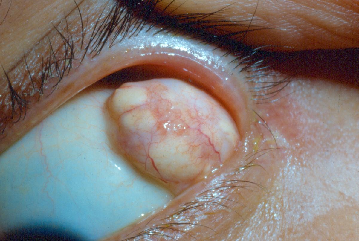 Dermoid cyst of orbit © 2017 American Academy of Ophthalmology