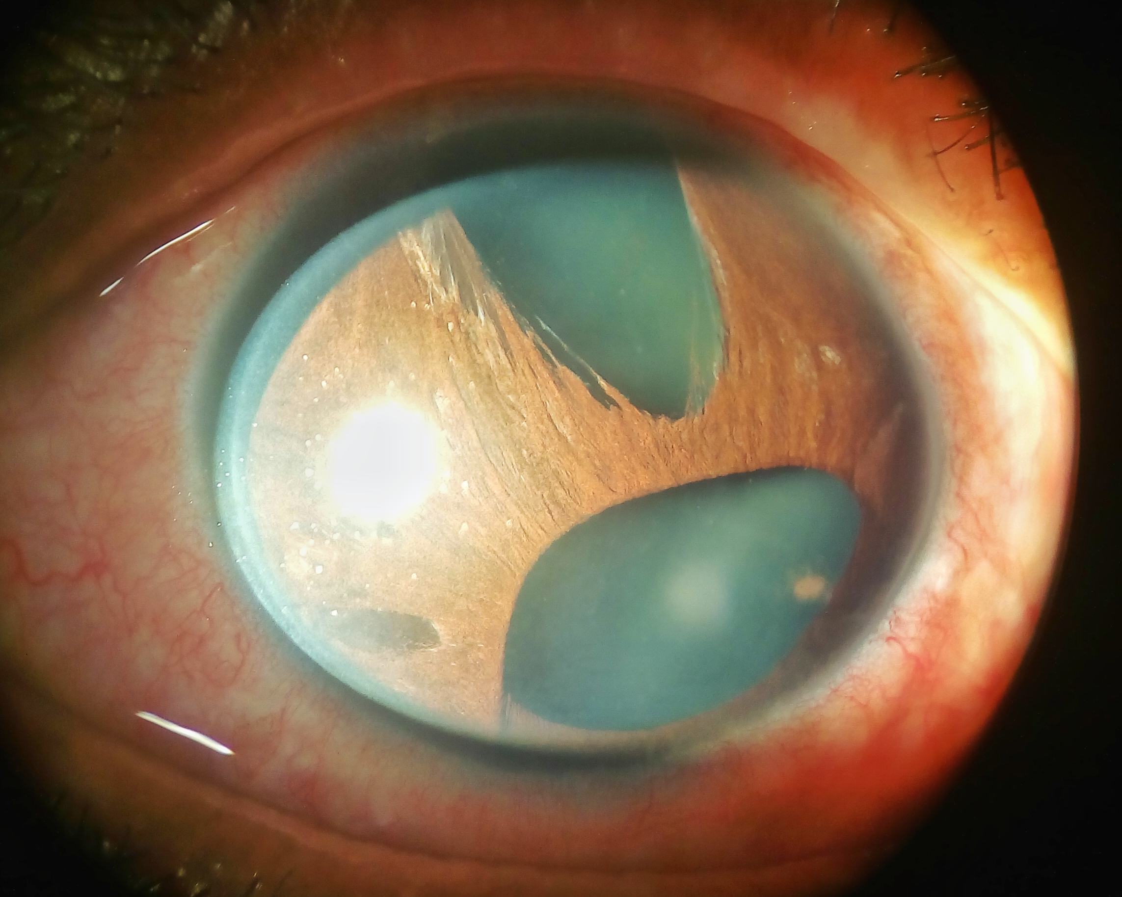 Polycoria, corectopia and area of iris atrophy