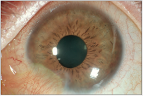 Grade II burn, focal conjunctivalization.png