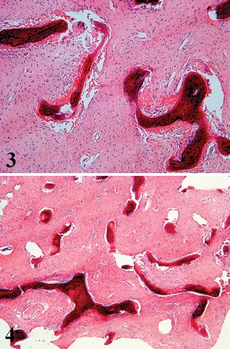 Fibrous Dysplasia Histology.jpg