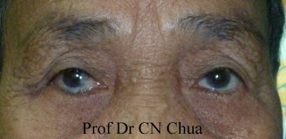 Entropion of the right lower eyelid. The marginal structures are rotated posteriorly. Credit: Dr. CN Chua