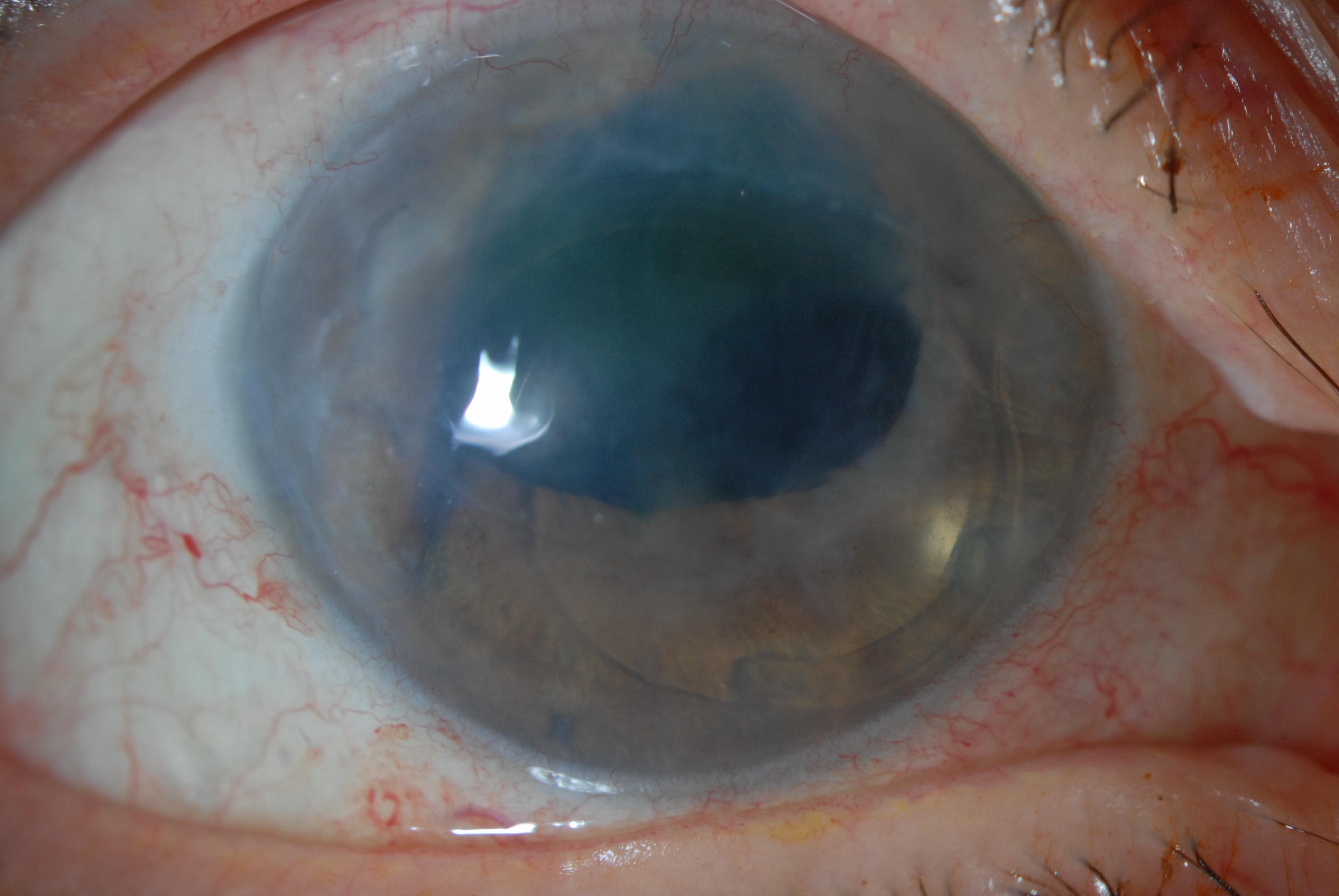 Pseudophakic corneal edema