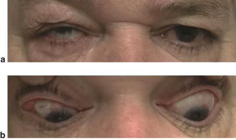 Strabismus secondary to implantation of glaucoma drainage device.