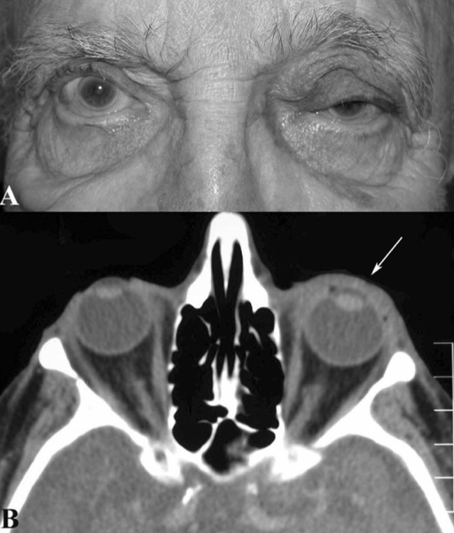 Figure 1: Orbital amyloidosis Diffuse infiltration by amyloidosis seen throughout patient’s left anterior orbit (white arrow) without any posterior orbital involvement. (Reprinted from Periocular and Orbital Amyloidosis: Clinical Characteristics, Management, and Outcome. Ophthalmology 2006;113:1657-64 with permission from Elsevier.)11