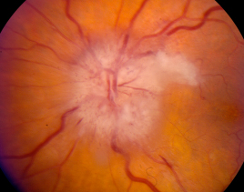 Typical findings in a patient with arteritic ischemic optic neuropathy. Note the pallid optic disc edema, associated hemorrhages, and adjacent cotton wool spot. Photograph courtesy of Dr. Nicholas Volpe.