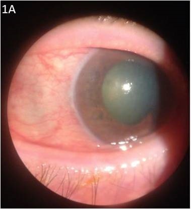 Figure 1A. Color photo showing the hyperemic conjunctiva, advanced cataract and a mid-dilated pupil.