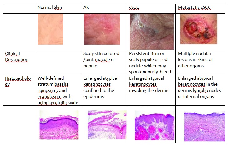 Figure 5.A clinical, histologic, and molecular comparison of AKs, cSCC, and metastatic cSCC Adapted from Ratushny, V., Gober, M. D., Hick, R., Ridky, T. W., & Seykora, J. T. (2012). From keratinocyte to cancer: the pathogenesis and modeling of cutaneous squamous cell carcinoma. The Journal of Clinical Investigation, 122(2), 464–47 Images kindly lent by Patricia Henriques Lyra Frasson M.D. , MSc - Federal University of Espirito Santo