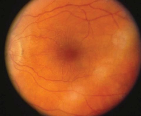 Hypotony maculopathy. Courtesy of Donald L. Budenz, MD, MPH.