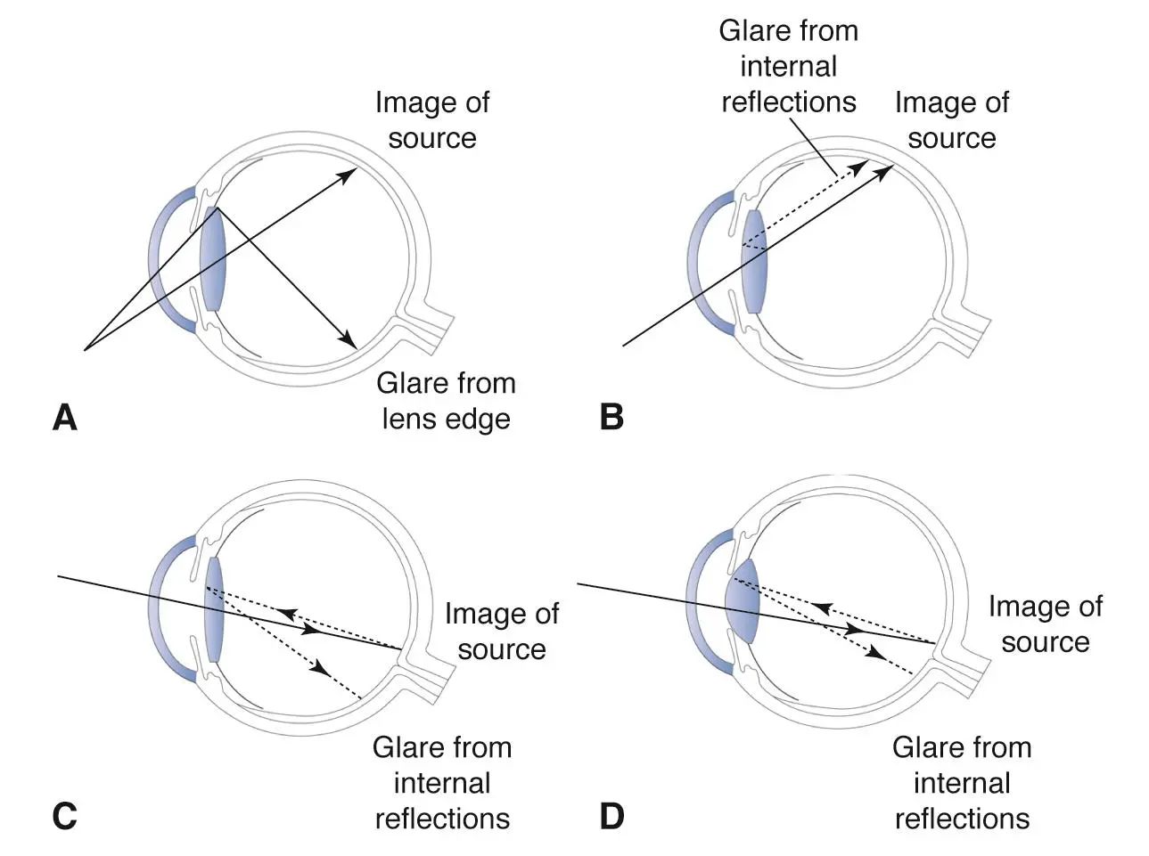 Lens-related vision disturbances