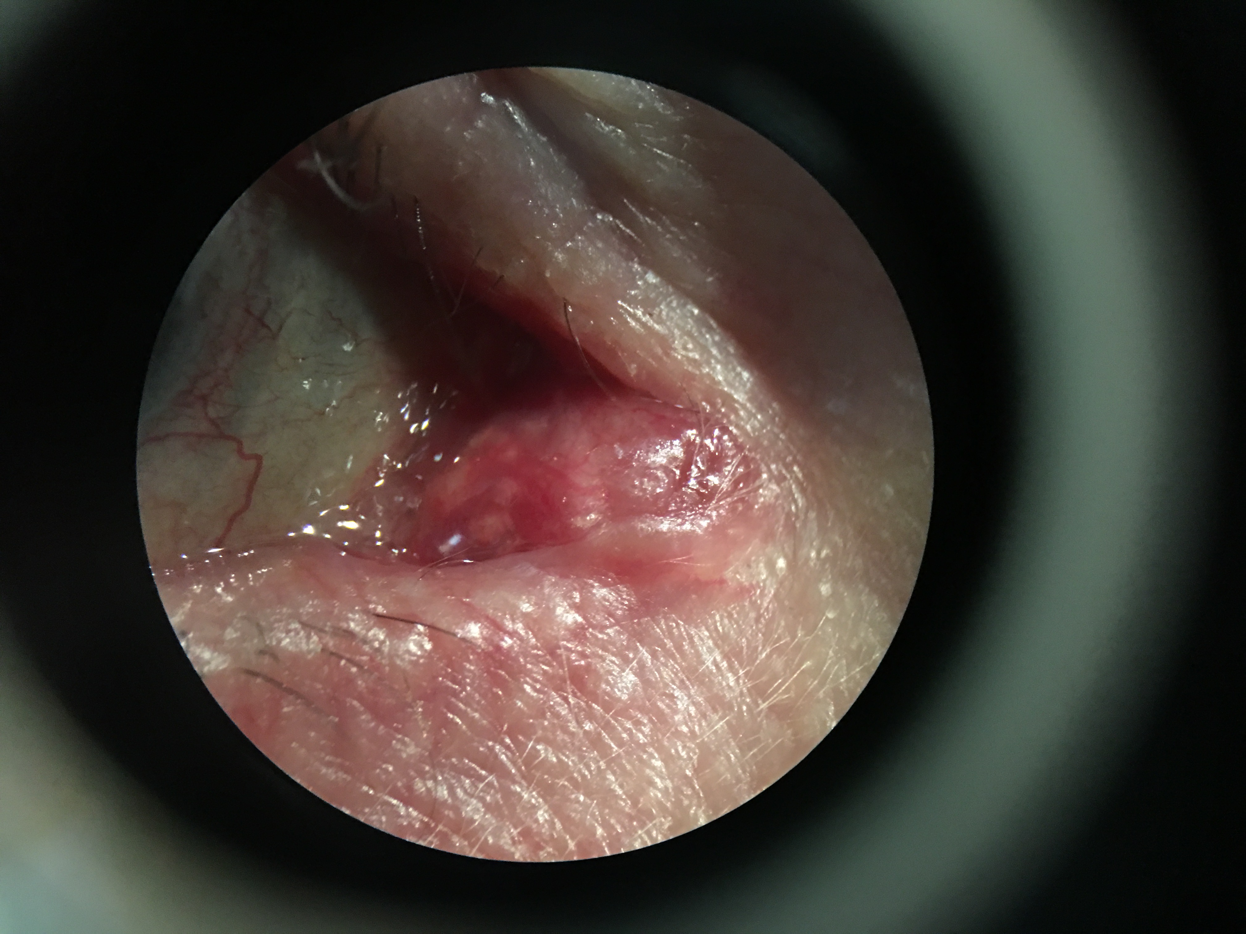 Oncocytoma of right caruncle through slit lamp. Photo courtesy of C.N. Burkat and R.C. Bowen