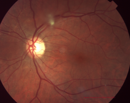 Figure 7: Retinal/Vitreous amyloidosis. Tuft of vitreous amyloidosis emanating from retina and overlying superior vascular arcade. (Image courtesy of Anh-Danh Phan, MD)