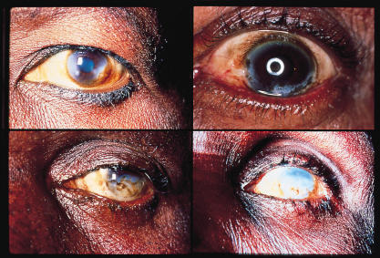 Progressive sclerosing keratitis associated with onchocerciasis infection