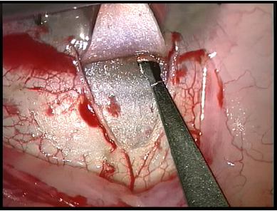 Figure 8: Superficial scleral flap dissection