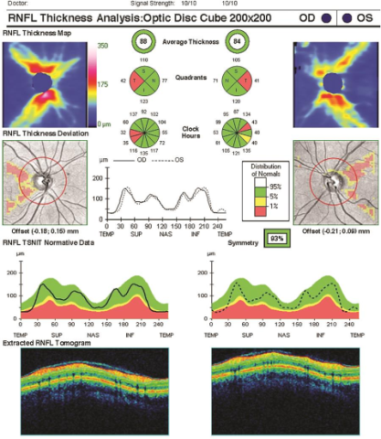 OCT of the nerve fiber layer