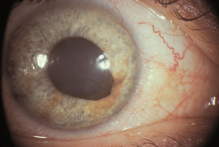 Inferonasal mass.