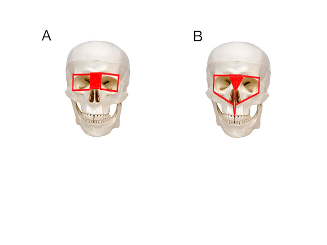 Figure 2 – A: Box osteotomy; B: Facial bipartition.