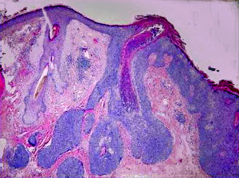 Sebaceous carcinoma histopathology