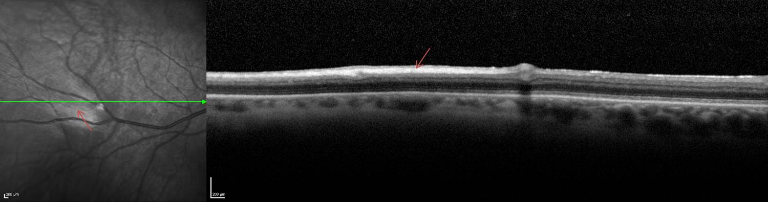 MRNFL IR and OCT arrows.jpg