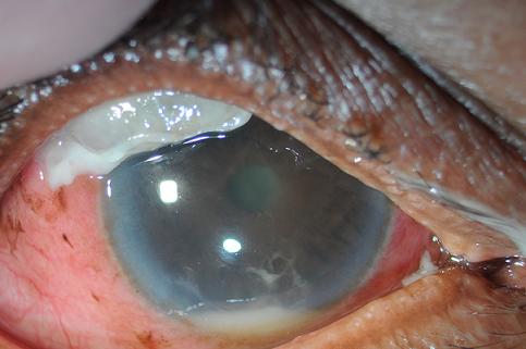 Slide 4. Photograph of BAE demonstrating mattering of lashes, markedly hyperemic conjunctiva, opacified bleb with purulent adherent material, hypopion, and fibrinous AC reaction.