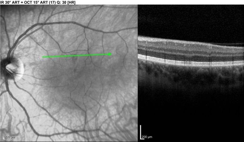 Infrared view of macular lesion (LEFT). Focal signal reduction of IS/OS junction on SD-OCT cross-section