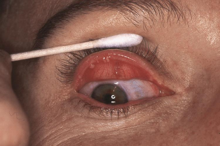 Eyelid nodules in multiple endocrine neoplasia