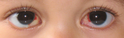 10.07.09 Day 5 after Eye Surgery.jpg