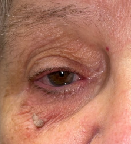 External photograph of seborrheic keratosis