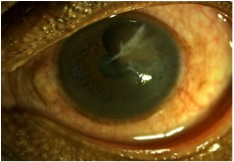 Iris cyst