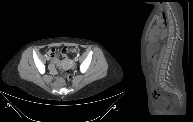 Figure 2a. 56mm soft tissue mass in the R pelvis anterior to sacrum,to the right of the rectum. Soft tissue going into or out of the S4 neural foramen. Figure 2b. Sagittal image of bony lytic lesions into spinal cord