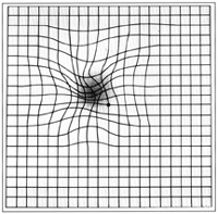 Hypothetical neovascular ARMD change on an Amsler grid.