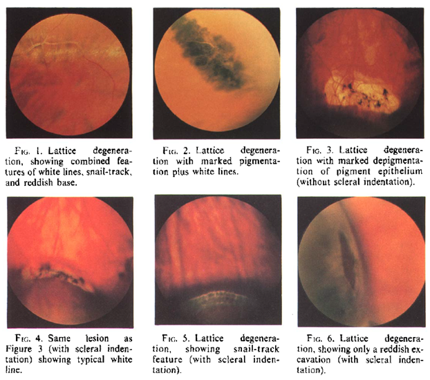 Byer NE. Lattice degeneration of the retina. Surv Ophthalmol. Jan-Feb 1979;23(4):213-48.