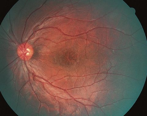 Foveal microcystic changes as characteristically seen in patient with X-linked juvenile retinoschisis.