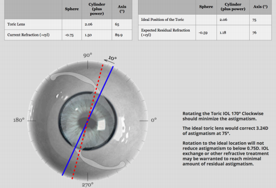 Sample print-out from toric IOL rotation calculator