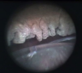 ECP treated ciliary processes (courtesy of Stanley Berke M.D.)