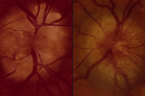 Pseudopapilledema and papilledema