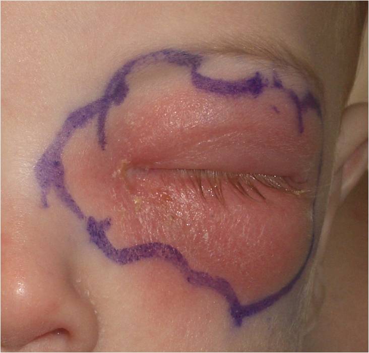 8-month old with recent upper respiratory infection and orbital cellulitis. Infection resolved with intravenous antibiotics.