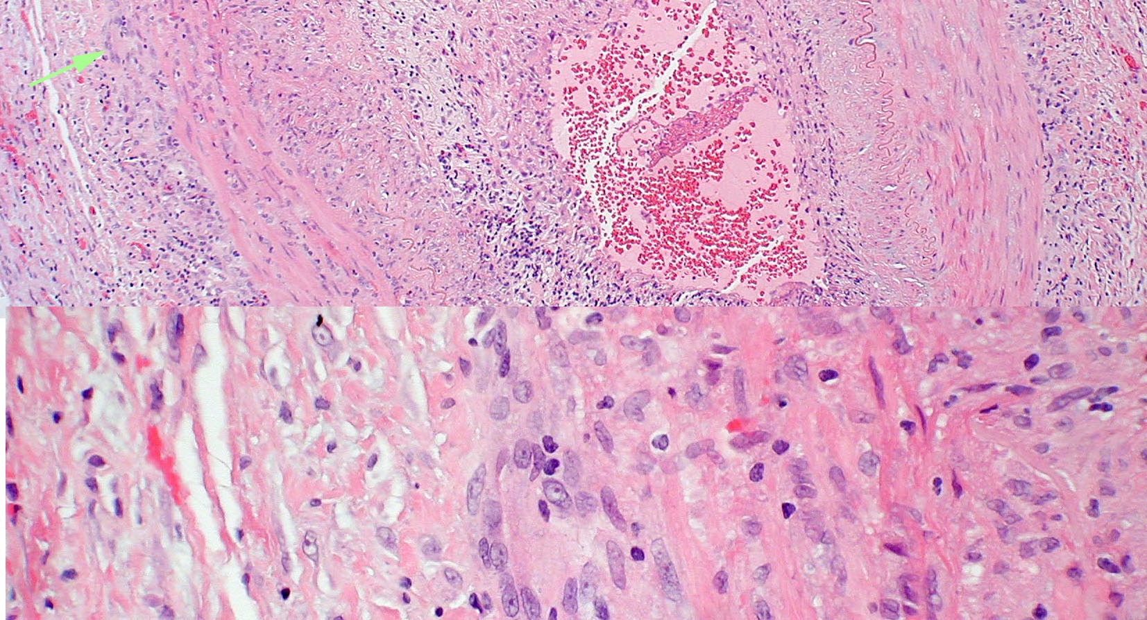 Pathologic specimen from a patient with biopsy proven giant cell arteritis. Multi-nucleated giant cells (arrow) are present in the vessel wall. Photograph courtesy of Ben Glasgow, M.D.