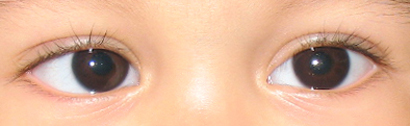 10.02.09 Day of Eye Surgery (1).jpg