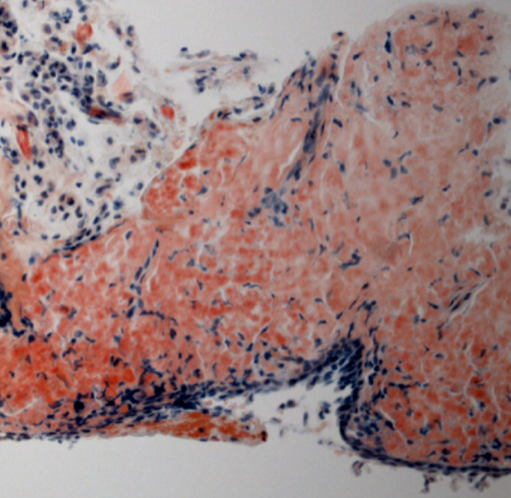 Figure 3: Conjunctival amyloidosis: Congo Red stain. Same patient as in Figure 2, showing conjunctiva with acellular eosinophilic deposits in the stroma. The deposits stain with Congo Red and are birefringent. (Image courtesy of Paul J. Bryar, MD)