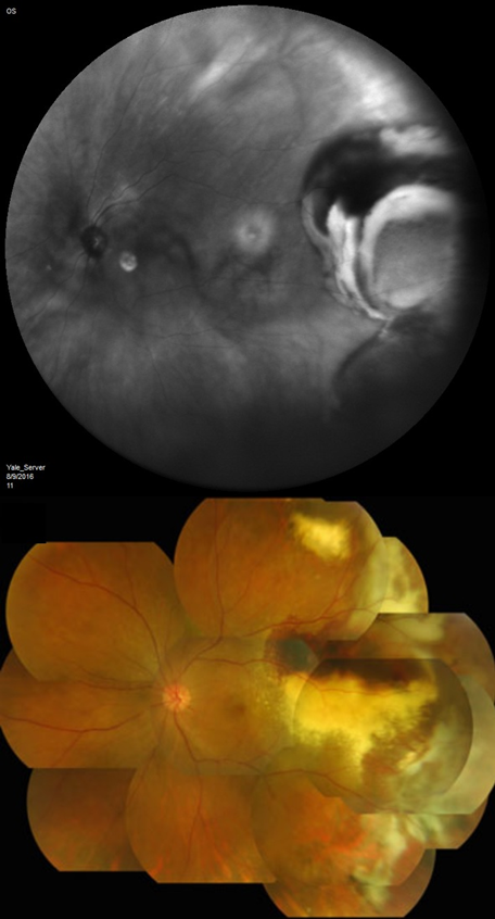 Peripheral exudative hemorrhagic chorioretinopathy