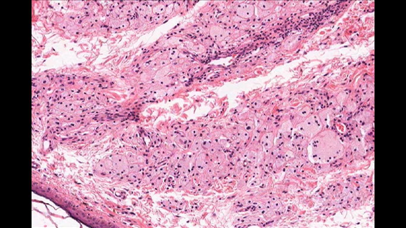 Xanthelasma Cells.jpg