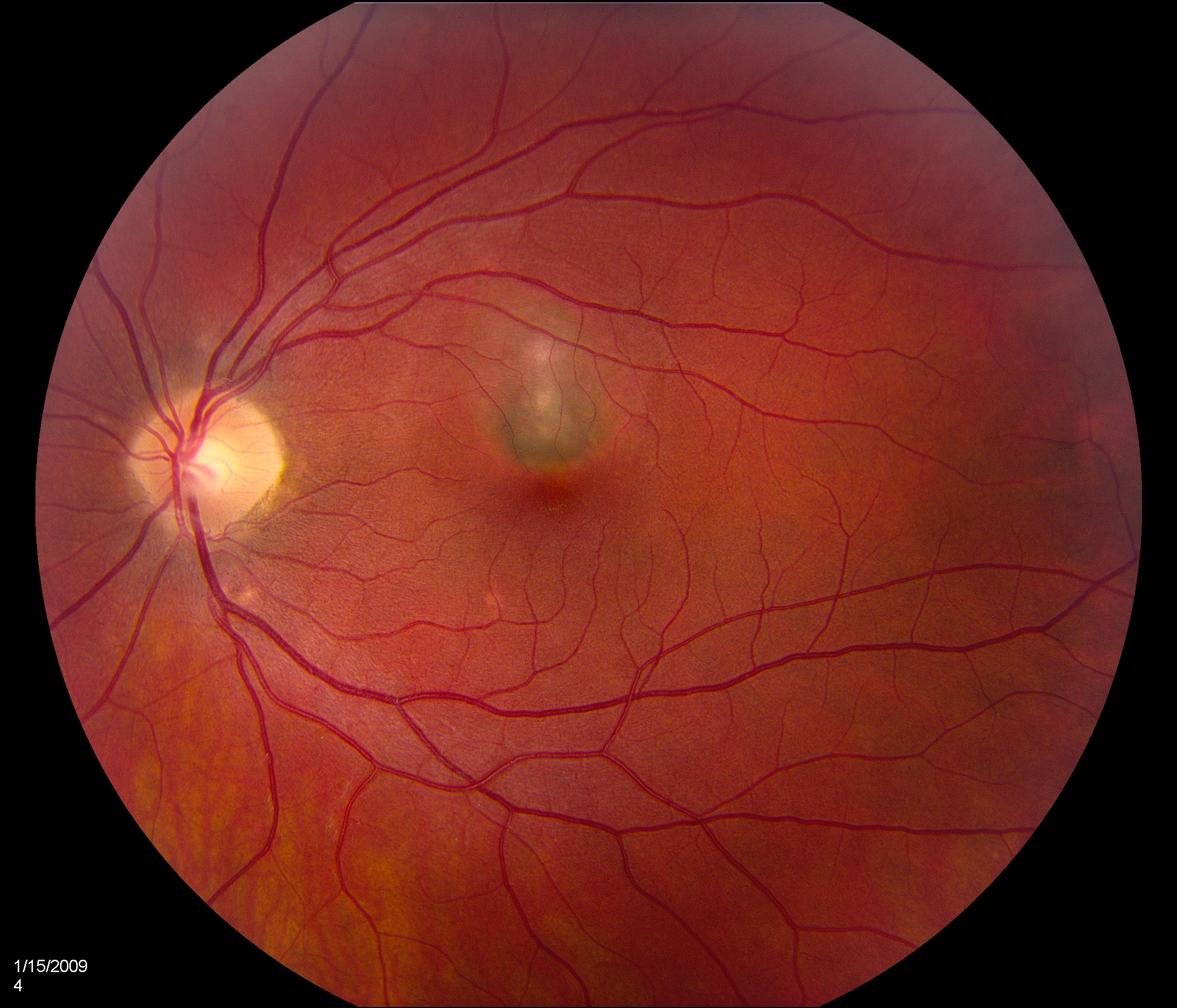 Color fundus photograph 3 months after second injection of bevacizumab shows a grayish subfoveal CNV membrane.